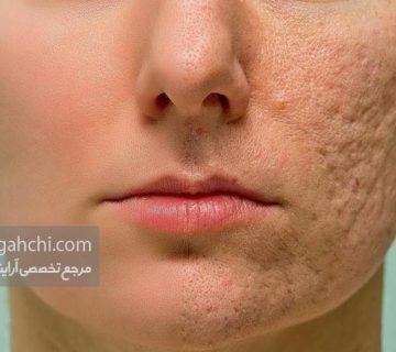 سابسیژن چیست
