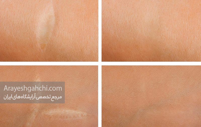 سابسیژن برای جای زخم