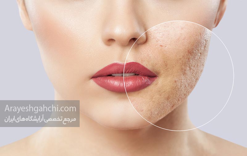 سابسیژن پوست