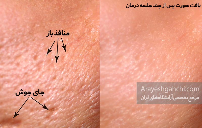 لیزر co2