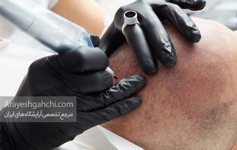 میکروپیگمنتیشن موی سر
