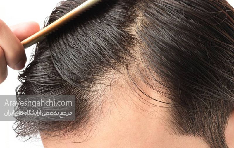 اسکالپ سر