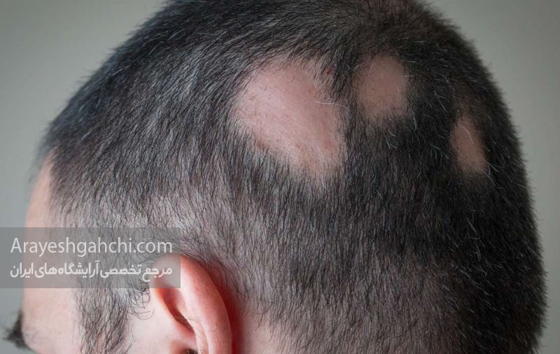 میکروپیگمنتیشن موی سر