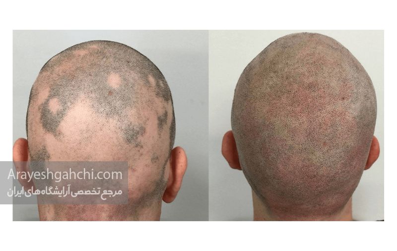 اسکالپ موی سر