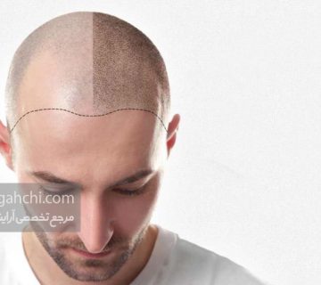 میکروپیگمنتیشن موی سر