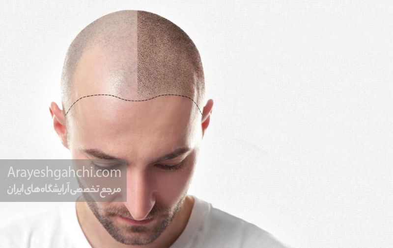 میکروپیگمنتیشن موی سر