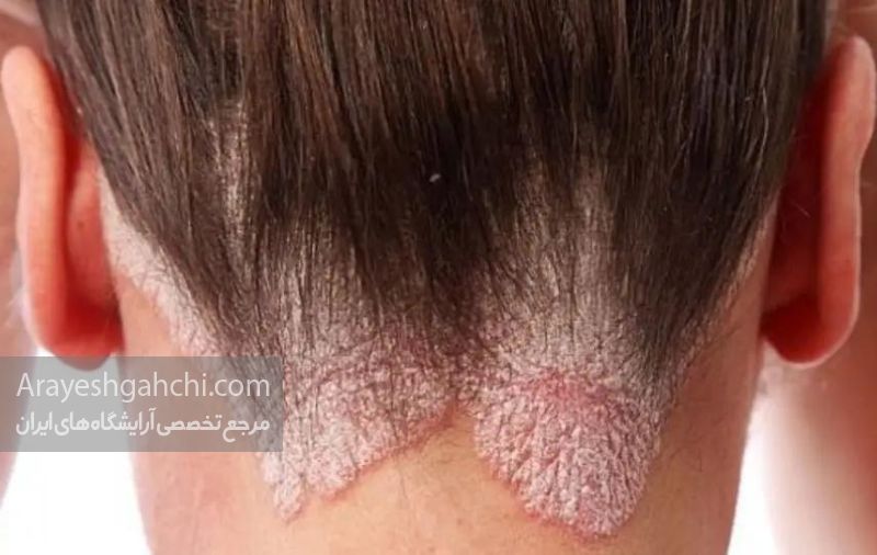 درماتیت سبوره ای
