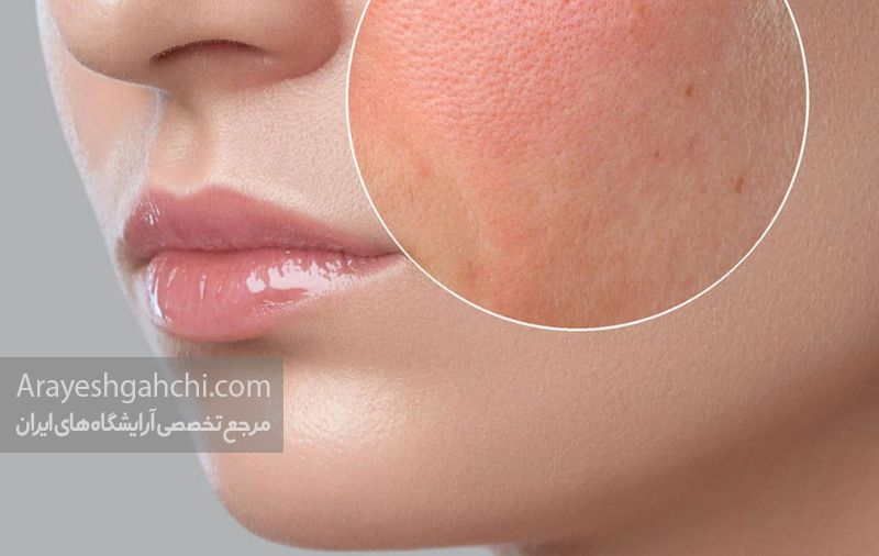 روتین پوست خشک